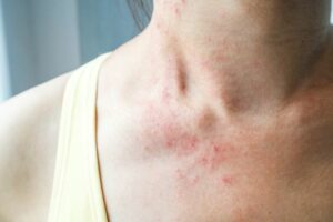 Causes of Alpha gal allergy and what are its symptoms