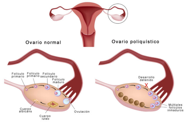 Cure Polycystic Ovarian Syndrome AHealthGuide