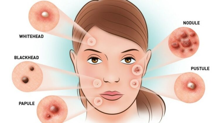 how-to-get-rid-of-pimples-with-these-effective-home-remedies-ahealthguide