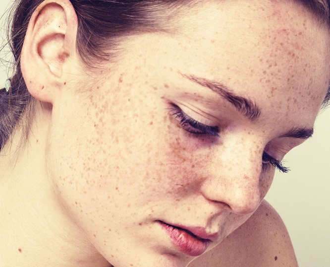 Lighten Freckles With Home Remedies Ahealthguide 8807